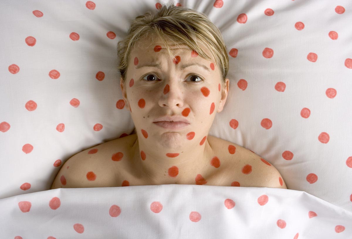 Patient-Sick-Measles-Chick-Pocks-Red-Marks-Spots